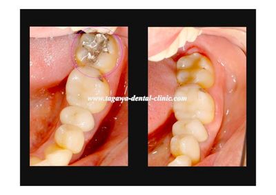 direct bonding page003.jpg